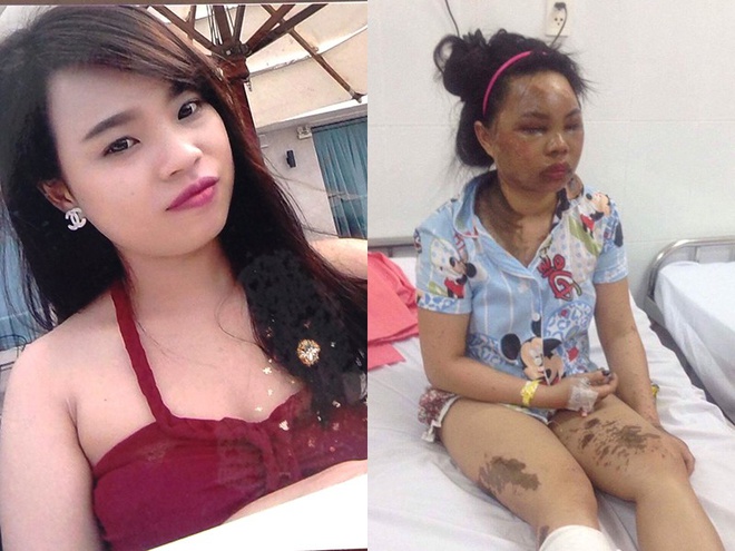 Nỗi đau của cả gia đình bị tạt axít-1