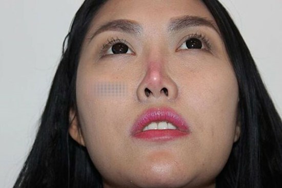 Những mỹ nhân Việt gặp biến chứng vì thẩm mỹ hỏng