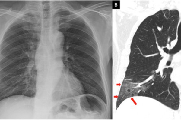 Chỉ còn 53 bệnh nhân mắc Covid-19 đang điều trị, phi công người Anh đã ổn định-2