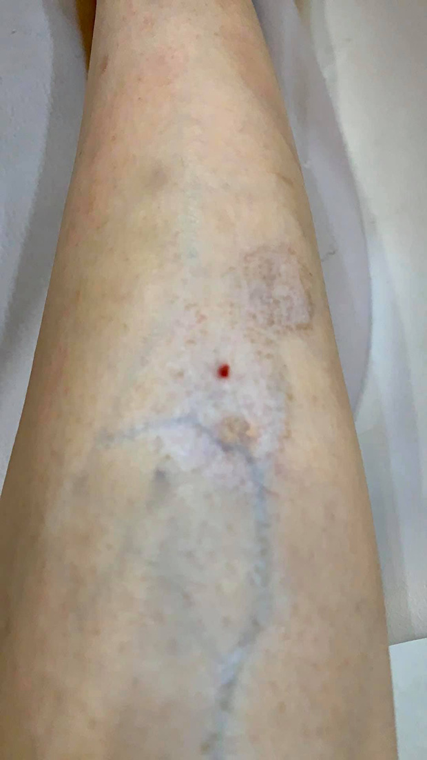 Hot girl Người ấy là ai bị teo cơ, giãn tĩnh mạch do tiêm xóa thâm sai cách: Sẽ đi Singapore khám sớm để tránh gây thêm biến chứng-2