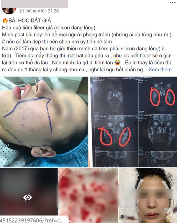 Bị lừa tiêm silicon lỏng đội mác filler, cô gái trẻ gặp biến chứng kinh hoàng, phải nạo vét khuôn mặt: Cảnh báo quan trọng chị em phải biết khi làm đẹp-1