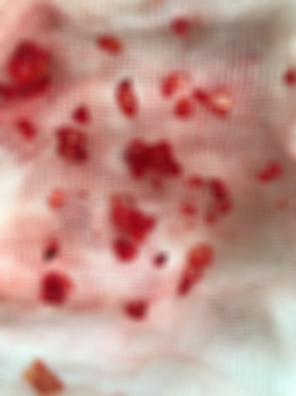 Bị lừa tiêm silicon lỏng đội mác filler, cô gái trẻ gặp biến chứng kinh hoàng, phải nạo vét khuôn mặt: Cảnh báo quan trọng chị em phải biết khi làm đẹp-2