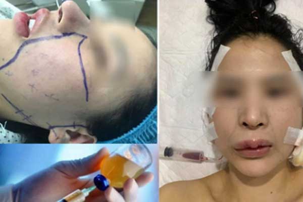 Tai nạn thẩm mỹ gây sốc trên MXH: Mặt sưng vù, lở loét sau thời gian ngắn tiêm filler mũi, cư dân chia sẻ ầm ầm vì quá sợ hãi!-4