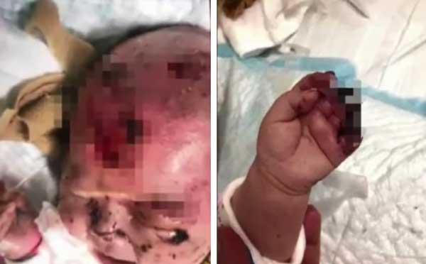 Bé gái 3 tháng tuổi đang ngủ thì bị tổn thương đầu và hoại tử bàn tay trái bởi nghi phạm ít ai nghĩ đến-1