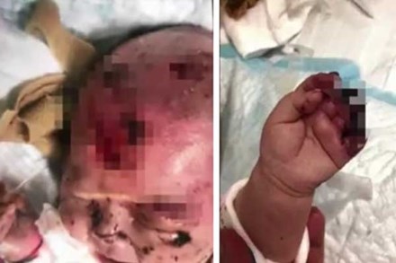 Bé gái 3 tháng tuổi đang ngủ thì bị tổn thương đầu và hoại tử bàn tay trái bởi 