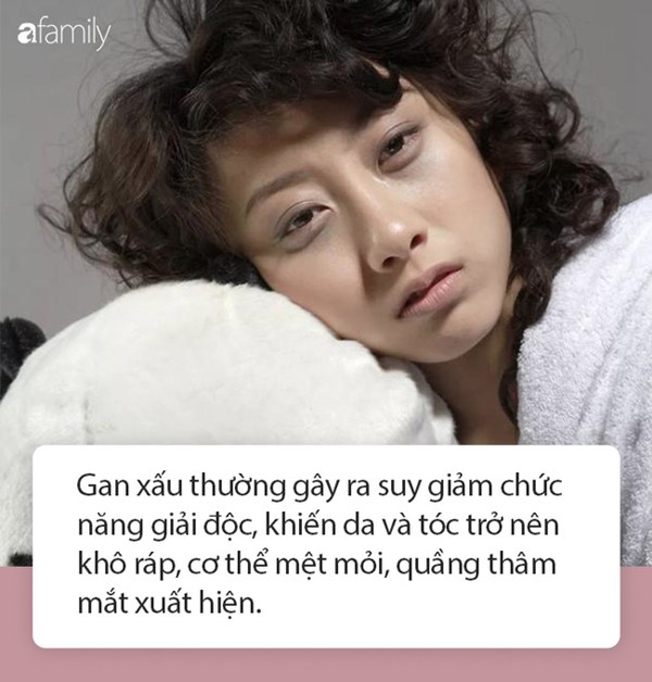 Quầng thâm mắt không chỉ do thiếu ngủ mà có thể là biểu hiện gan đang rất xấu: Cần bổ sung ngay 2 loại thực phẩm này để giải độc hiệu quả-1