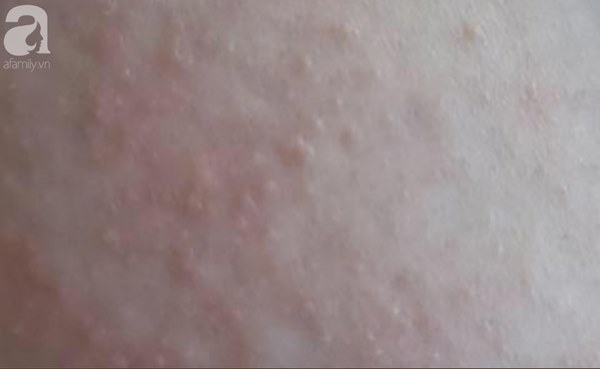 Cảnh báo dùng rượu gừng nghệ hạ thổ làm đẹp cho phụ nữ sau sinh-2