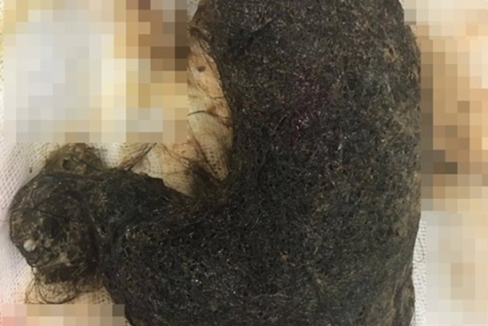 Bé gái 11 tuổi ở Hà Nội có khối u khổng lồ trong cơ thể chứa toàn tóc, nguyên nhân do 1 thói quen từ năm 2 tuổi của bé