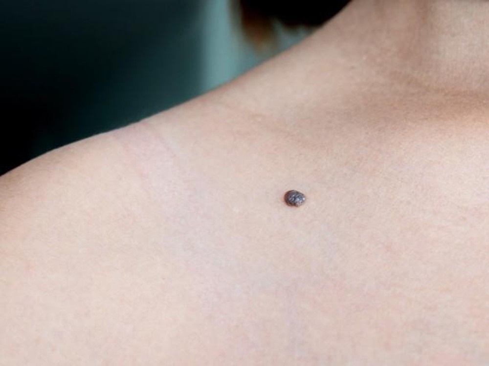 Đừng chần chờ mà hãy đi khám ngay khi bạn thấy mình dù chỉ có 1 trong 10 dấu hiệu sau đây, vì có thể bạn đang ở giai đoạn đầu của các bệnh ung thư-3