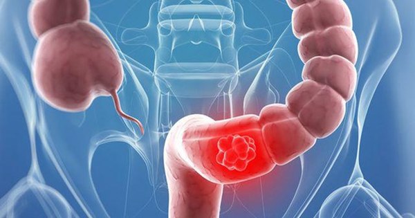 Bác sĩ cảnh báo 5 kiểu người có nguy cơ mắc ung thư đại tràng rất cao, nên khám gấp-3