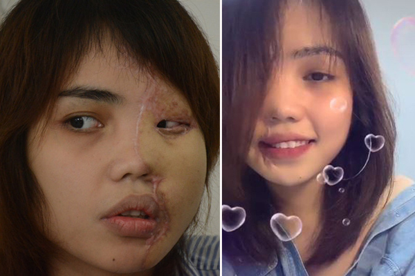 4 năm tìm lại bình yên của cô gái bị chồng tưới xăng thiêu sống-7