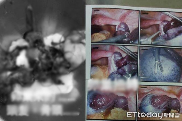 Bé 9 tuổi bị hoại tử toàn bộ buồng trứng phải cắt bỏ vì cha mẹ ngỡ con táo bón-2