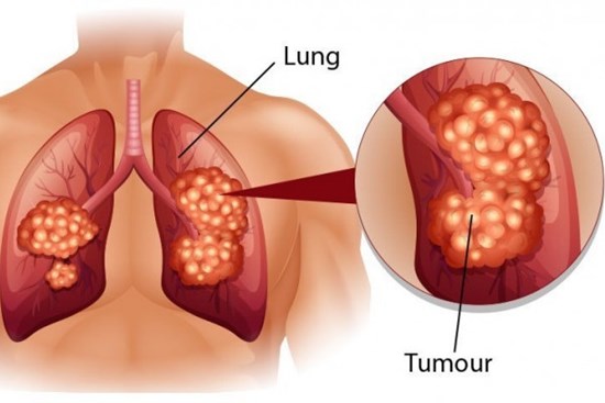 6 biện pháp phòng ung thư phổi