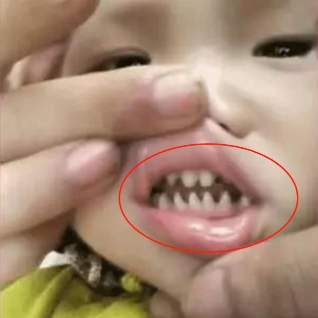 Con có hàm răng như răng cá mập, bà mẹ hối hận vì nguyên nhân là do mình-1