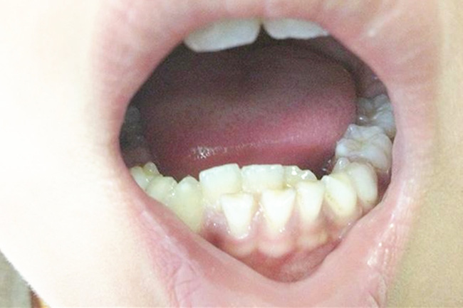 Con có hàm răng như răng cá mập, bà mẹ hối hận vì nguyên nhân là do mình-2