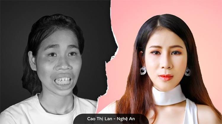 Cô gái Đồng Nai đổi đời sau 24 năm bị miệt thị người không môi-5
