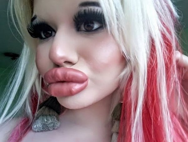 Bơm môi dày như cặp xúc xích chập đôi, tiêu chuẩn đẹp của một số cô gái sao lạ quá!-3