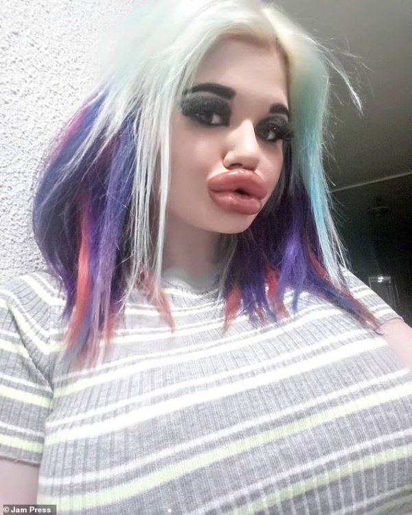 Bơm môi dày như cặp xúc xích chập đôi, tiêu chuẩn đẹp của một số cô gái sao lạ quá!-4