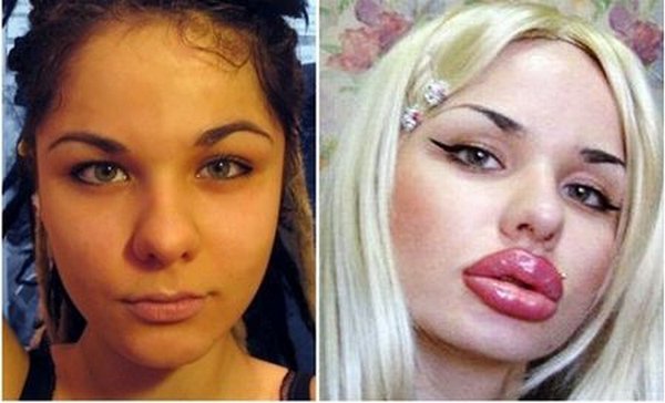 Bơm môi dày như cặp xúc xích chập đôi, tiêu chuẩn đẹp của một số cô gái sao lạ quá!-8