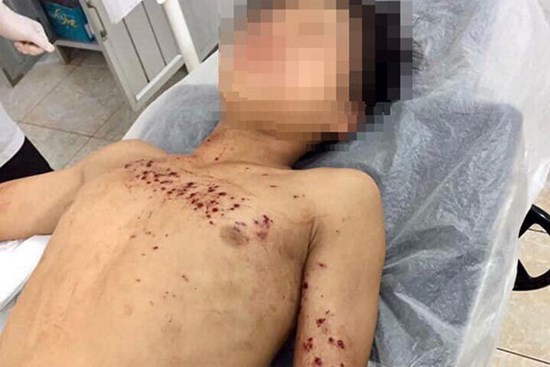 Dập nát bàn tay vì thói quen vừa sạc vừa dùng điện thoại