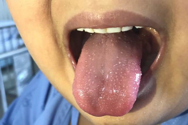 Mỹ xác nhận 38 trẻ em mắc hội chứng viêm hiếm gặp nghi do virus SARS-CoV-2-1