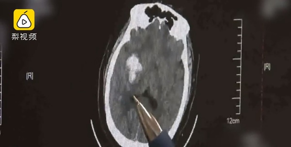 Chàng trai 9X đột nhiên tê liệt cả người, nói năng không rõ ràng, nguyên nhân do thói quen thức khuya, ăn nhiều thức ăn nhanh-1