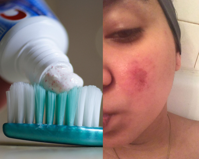 4 mẹo chăm da được chị em truyền tai nhau từ năm này qua tháng khác nhưng bác sĩ da liễu lại kịch liệt phản đối-2