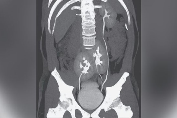 Bị đau lưng, người đàn ông đi khám mới biết mình có tới 3 quả thận-1