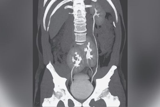 Bị đau lưng, người đàn ông đi khám mới biết mình có tới 3 quả thận