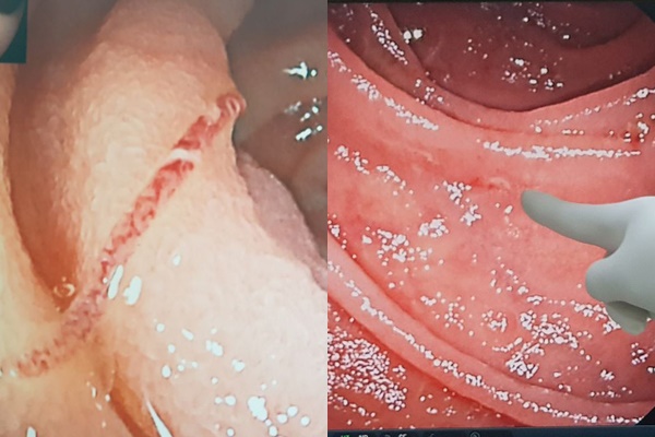 Giun lúc nhúc đâm thủng ruột người đàn ông Lào Cai-1