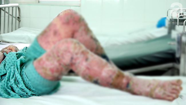 Mua thuốc trị vảy nến trên mạng giá 200 ngàn đồng, người đàn ông ở Đắk Lắk bị sưng phù đau nhức khủng khiếp-1