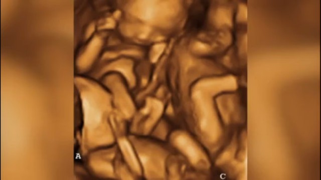 Thiếu nữ 16 tuổi tuyên bố mang bầu 3 thai, gia đình và bạn trai chưa hết ngạc nhiên thì sự thật đằng sau được phơi bày-2