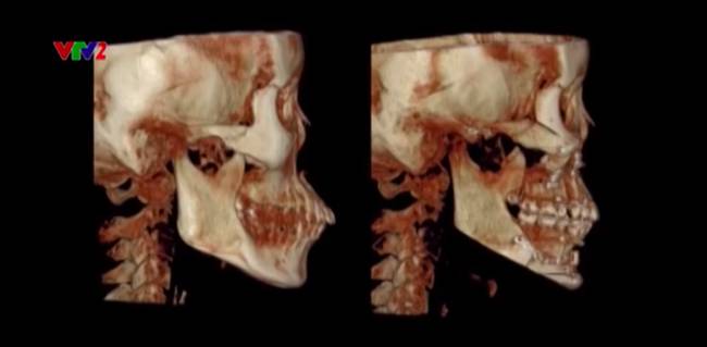 Nữ chính xinh như mộng của Người Ấy Là Ai lần đầu kể chuyện nói dối bố để sang Hàn Quốc phẫu thuật thẩm mỹ, nhan sắc thay đổi khiến gia đình tưởng người lạ-5