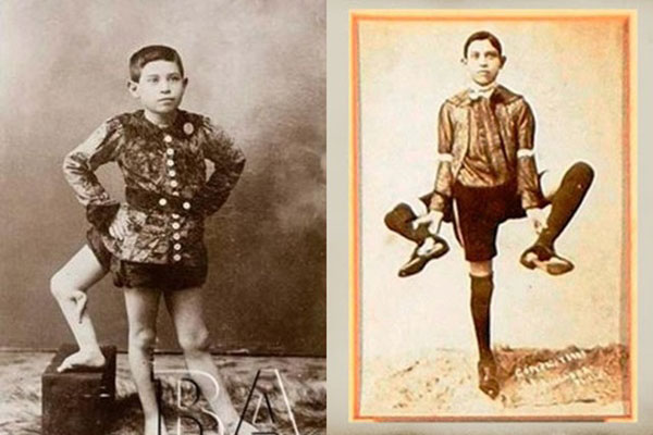 Chuyện về gã dị nhân Cậu bé Tôm Hùm: Mua vui cho thiên hạ nhưng lại là nỗi ám ảnh của gia đình vì thói bạo hành, say xỉn-5