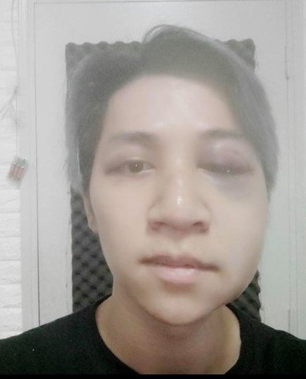 Ca sĩ Bùi Duy Ngọc chấn thương não, liệt nửa mặt vì tai nạn-2