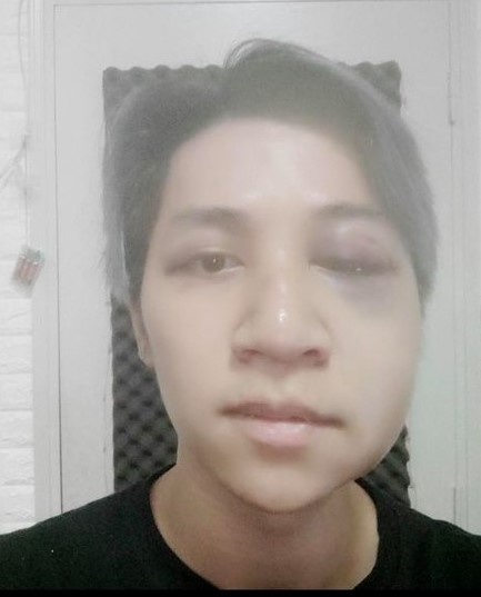 Ca sĩ Bùi Duy Ngọc chấn thương não, liệt nửa mặt vì tai nạn-2