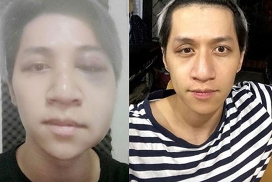 Ca sĩ Bùi Duy Ngọc chấn thương não, liệt nửa mặt vì tai nạn