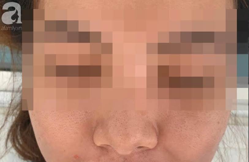 Đắp mặt nạ làm trắng da giá 600.000 đồng, mặt người phụ nữ sưng phù, mụn mủ nhiều kinh khủng-2