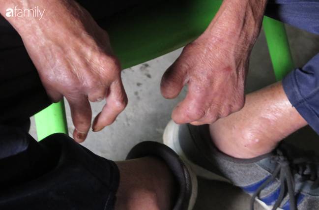 Tâm sự người đàn ông khuyết tật cả 2 tay, ngày ngày bán phế liệu nuôi 2 cháu sinh đôi cùng mẹ già 91 tuổi: Tôi không dám chết-2