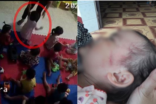 Bắc Giang: Nghi vấn cơ sở mầm non tư thục bạo hành dã man bé gái hơn 2 tuổi khi mới nhập học 3 ngày