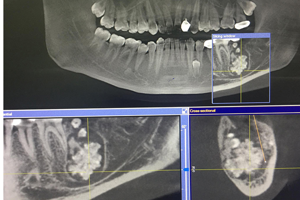 Bác sĩ gắp răng lúc nhúc trong miệng nam thanh niên Hà Nội-1