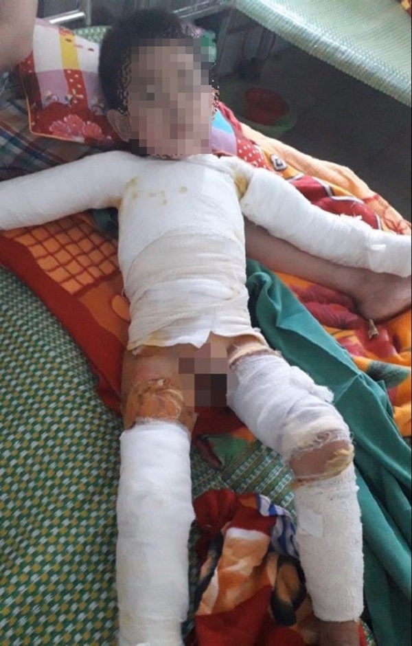 Bé trai 5 tuổi bỏng nặng toàn thân do nghịch bật lửa-1