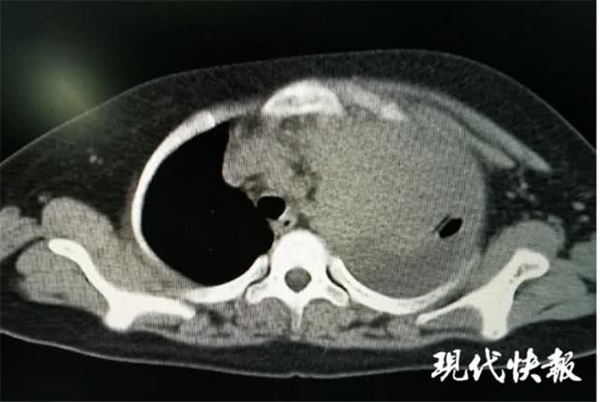 Một bên phổi của con trai bỗng biến mất một cách kỳ lạ, bố mẹ và bác sĩ bàng hoàng nhận ra đó là khối u ác tính hiếm gặp-1