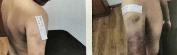 Gửi con cho cô giáo thân thiết dạy kèm, mẹ đâu ngờ giao trứng cho ác khi biết con bị đánh 1500 roi khiến 1/4 cơ thể tổn thương-1