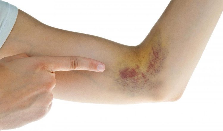 Mẹo hiệu quả làm các vết bầm tím trên da tan nhanh-1