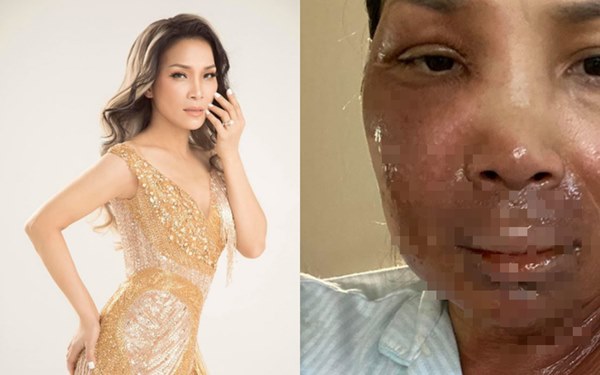 Ca sĩ Hồng Ngọc bất ngờ công khai ảnh bị bỏng 2/3 gương mặt-2