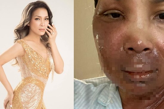 Ca sĩ Hồng Ngọc bất ngờ công khai ảnh bị bỏng 2/3 gương mặt