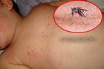 6 hiểu lầm nguy hiểm về bệnh sốt xuất huyết có thể khiến người bệnh tử vong-4