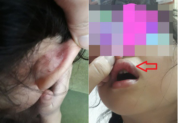 Hà Nội: Cô giáo tiểu học bị tố dùng tay, sách đánh học sinh chảy máu, dập môi tại trường học-1