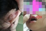 Vụ phụ huynh ở Hà Nội tố con gái bị đánh véo đến dập môi tụ máu, cô giáo giải thích Con tự cạy vảy ở môi-5